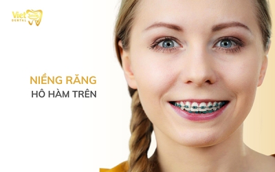 Niềng răng hô hàm trên có được không? Đâu là phương pháp hiệu quả?
