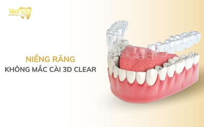 Niềng răng không mắc cài 3D Clear có hiệu quả không?