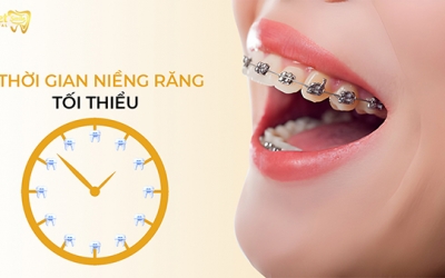 Thời gian niềng răng tối thiểu là bao lâu?
