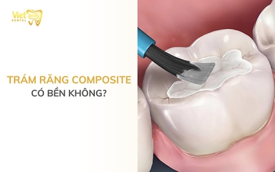 Trám răng Composite có bền không? Lưu ý khi trám răng Composite