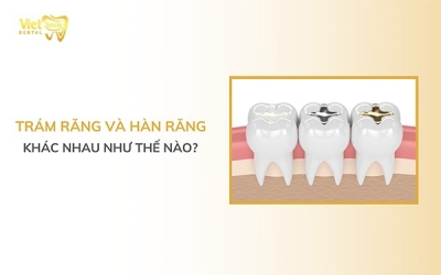 Trám răng và hàn răng khác nhau như thế nào?