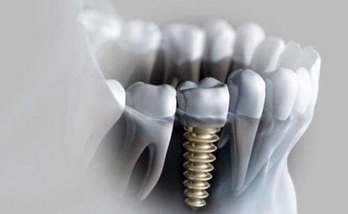 Cấy ghép implant hay trồng răng implant là gì?