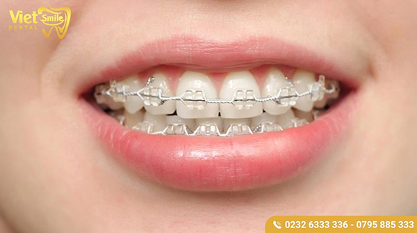 Trường hợp có thể niềng răng khi trồng răng giả