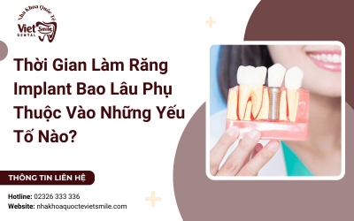 Thời Gian Làm Răng Implant Bao Lâu Phụ Thuộc Vào Những Yếu Tố Nào?