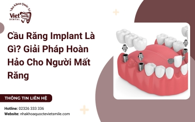 Cầu Răng Implant Là Gì? Giải Pháp Hoàn Hảo Cho Người Mất Răng