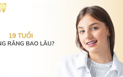 19 tuổi niềng răng bao lâu mới tháo niềng?