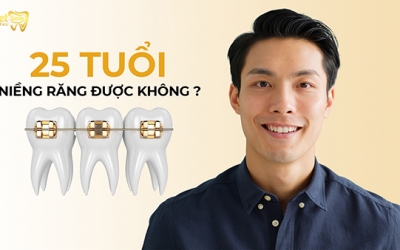 25 tuổi niềng răng được không? Giải đáp từ chuyên gia