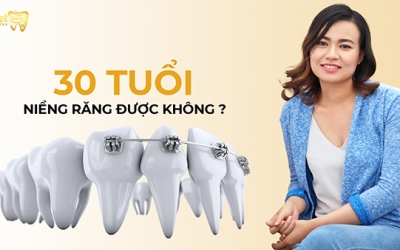 30 tuổi niềng răng được không, đã có lời giải đáp