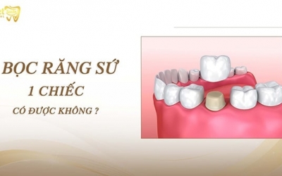 Bọc răng sứ 1 chiếc được không và những điều bạn cần biết