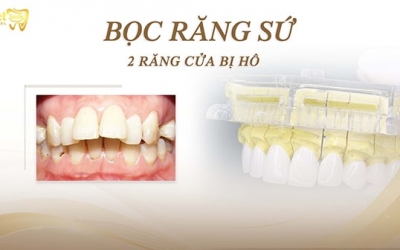 Bọc răng sứ 2 răng cửa bị hô được không?