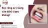 Bọc răng sứ 2 răng cửa bị hô được không?