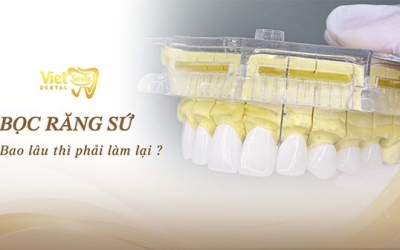 Bọc răng sứ bao lâu thì phải làm lại? Loại răng sứ nào bền nhất