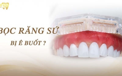 Nguyên nhân tại sao bọc răng sứ bị ê buốt và cách khắc phục hiệu quả