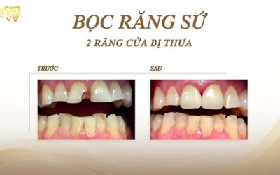 Có nên bọc răng sứ cho răng hô không? 