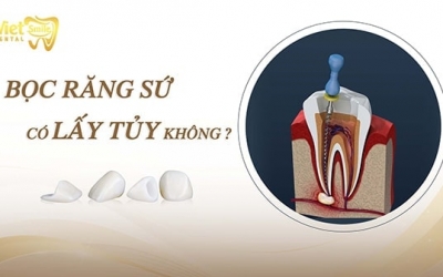 Bọc răng sứ có lấy tủy không? Những trường hợp không phải lấy tủy?