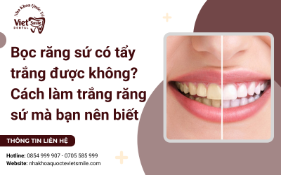 Bọc răng sứ có tẩy trắng được không? Cách làm trắng răng sứ mà bạn nên biết