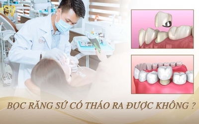 Bọc răng sứ có tháo ra được không? Cần lưu ý gì khi tháo răng sứ?