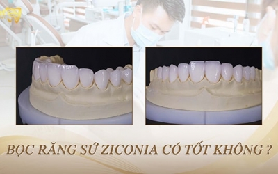 Bọc răng sứ Zirconia là gì? Liệu sứ Zirconia có thật sự tốt không?