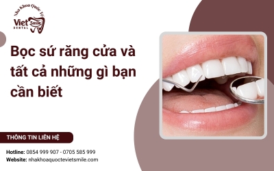 Bọc sứ răng cửa và tất cả những gì bạn cần biết