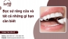 Bọc sứ răng cửa và tất cả những gì bạn cần biết