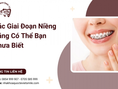 Các Giai Đoạn Niềng Răng Có Thể Bạn Chưa Biết