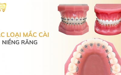 Các loại mắc cài niềng răng được nhiều người sử dụng hiện nay