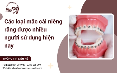 Các loại mắc cài niềng răng được nhiều người sử dụng hiện nay