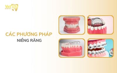 Các phương pháp niềng răng hiệu quả, loại nào nhanh nhất?