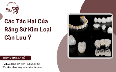 Các Tác Hại Của Răng Sứ Kim Loại Cần Lưu Ý