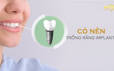 Có nên trồng răng Implant không? 6 ưu điểm vượt trội của trồng răng Implant