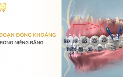 Giai đoạn đóng khoảng trong niềng răng mất bao lâu?