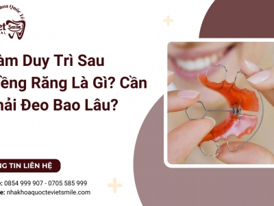 Hàm Duy Trì Sau Niềng Răng Là Gì? Cần Phải Đeo Bao Lâu?