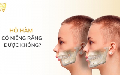 Hô hàm có niềng răng được không? Giải pháp nào tốt?