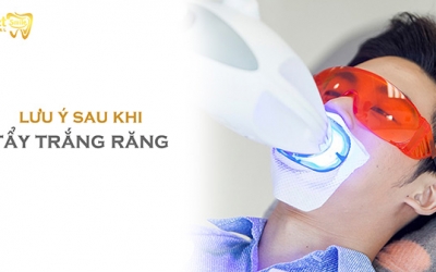 Những lưu ý sau khi tẩy trắng răng mà bạn nên biết