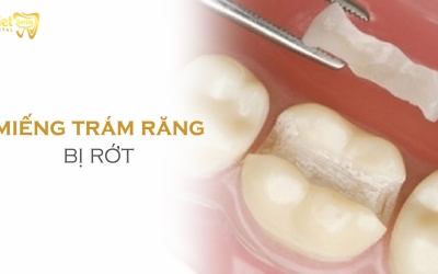 Miếng trám răng bị rớt: Nguyên nhân và cách khắc phục hiệu quả