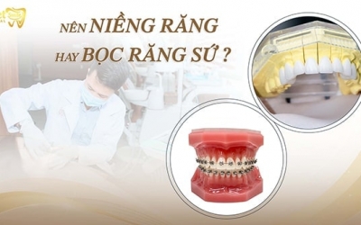 Nên niềng răng hay bọc sứ và một số lưu ý bạn nên biết