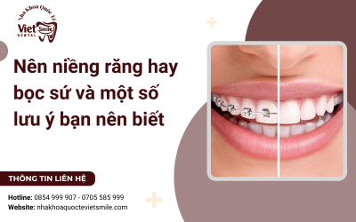Nên niềng răng hay bọc sứ và một số lưu ý bạn nên biết