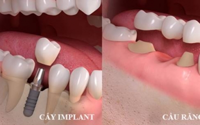 Mất răng nên trồng răng sứ hay Implant? So sánh ưu điểm từng loại