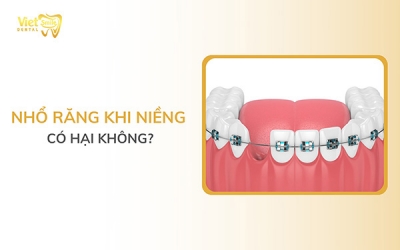 Nhổ răng khi niềng có hại không? Nó ảnh hưởng như thế nào đến sức khỏe?