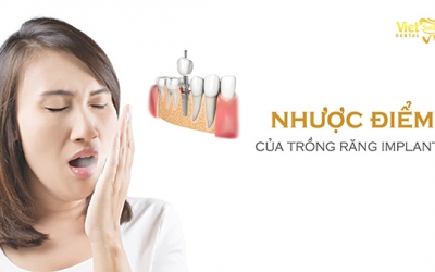 6 nhược điểm của trồng răng Implant đáng chú ý