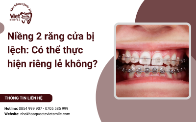 Niềng 2 răng cửa bị lệch: Có thể thực hiện riêng lẻ không?