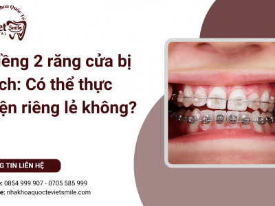 Niềng 2 răng cửa bị lệch: Có thể thực hiện riêng lẻ không?