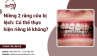 Niềng 2 răng cửa bị lệch: Có thể thực hiện riêng lẻ không?