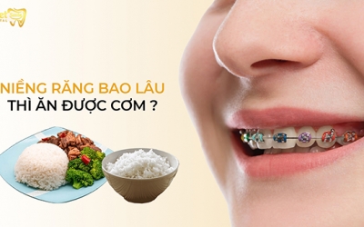 Niềng răng bao lâu thì ăn được cơm như bình thường?