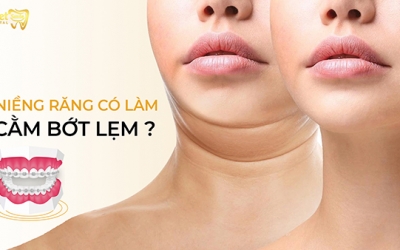 Niềng răng có làm cằm bớt lẹm không? Phương pháp nào hiệu quả?