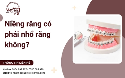 Niềng răng có phải nhổ răng không?