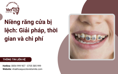 Niềng răng cửa bị lệch: Giải pháp, thời gian và chi phí