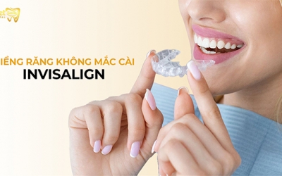 Niềng răng không mắc cài invisalign và những điều cần biết