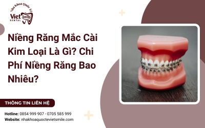 Niềng Răng Mắc Cài Kim Loại Là Gì? Chi Phí Niềng Răng Bao Nhiêu?