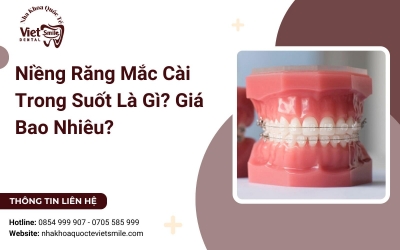 Niềng Răng Mắc Cài Trong Suốt Là Gì? Giá Bao Nhiêu?